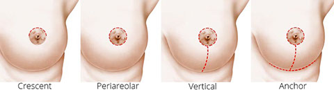 Periareolar Breast Reduction